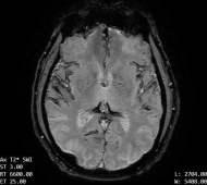 Decoding The Superficial Siderosis MRI