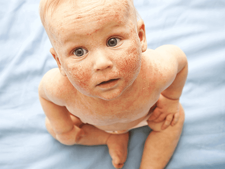 Eczema in Babies - Causes, Prevention and Treatment