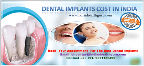 Dental Implants Cost In India