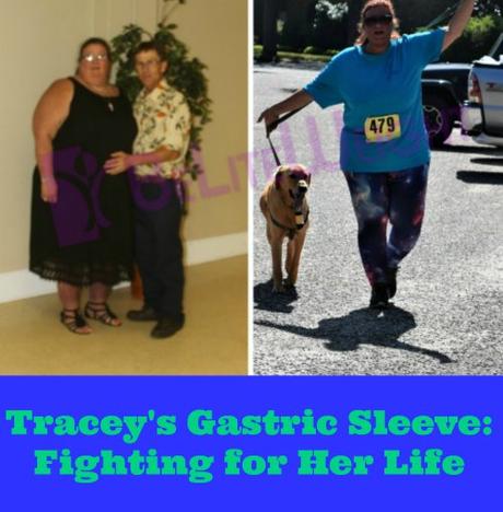 Tracey’s Gastric Sleeve: Fighting for Her Life