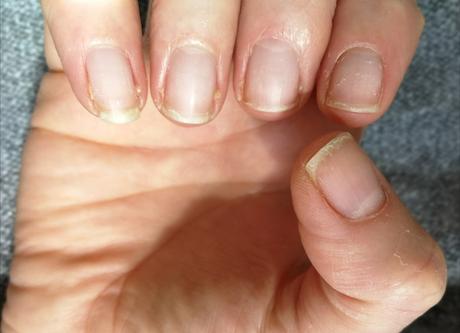 Is There Any Hope For Weak, Peeling Fingernails?