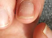 There Hope Weak, Peeling Fingernails?
