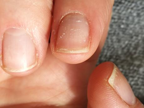 Is There Any Hope For Weak, Peeling Fingernails?