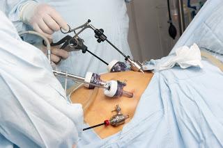 How Effective Is Laparoscopic Weight Loss Surgery?