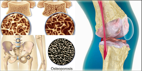 Management of Osteoporosis in Ayurveda – Natural Treatment