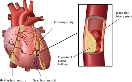 Heart Attack Warning signs you shouldn’t ignore!