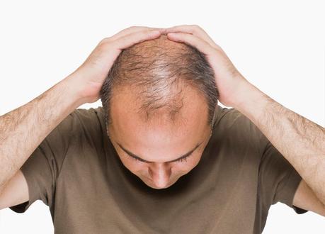 Male pattern baldness caused by elevated insulin?