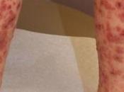 Treat Idiopathic Thrombocytopenic Purpura (ITP) Ayurveda