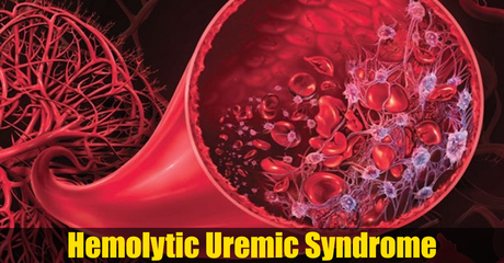 Treatment of Hemolytic Uremic Syndrome (HUS) in Ayurveda