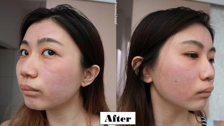 Removing Acne Scars in Singapore | Aesthetic Central Clinic CO2 Laser Treatment Session 4