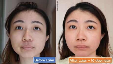 Removing Acne Scars In Singapore Aesthetic Central Clinic Co2