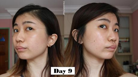 Removing Acne Scars in Singapore | Aesthetic Central Clinic CO2 Laser Treatment Session 4