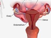 Endometriosis What Causes, Symptoms, Possible Complications, Diagnosis, Treatment Prevention
