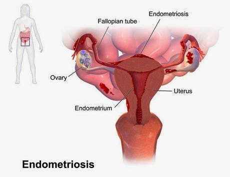 Endometriosis – What is It, Causes, Symptoms, Possible Complications, Diagnosis, Treatment and Prevention