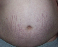 How to Avoid Stretch Marks During Pregnancy