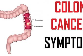 Stage 4 Colon Cancer Symptoms | Colorectal Cancer - Paperblog