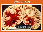 Herbal Remedies Multifocal Leukoencephalopathy