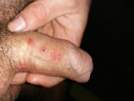 penis friction burn Penis friction burn