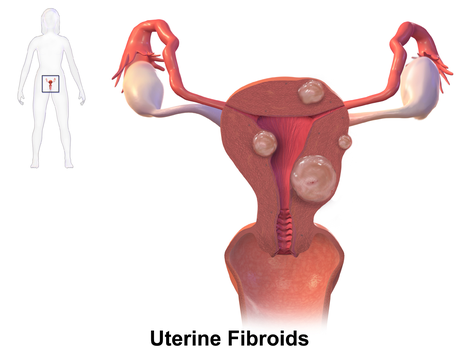 Image result for Fibroids: