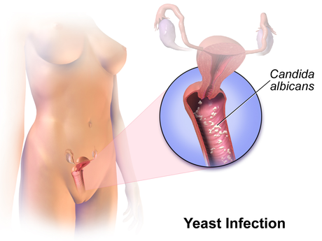 Image result for Vaginal Yeast infection