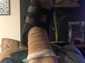 Decided Have Bunion Surgery