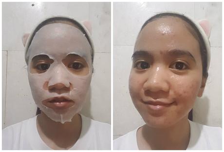 Does the Centellian 24 Madeca Derma Mask Reduces Your Acne or Dark Spots?