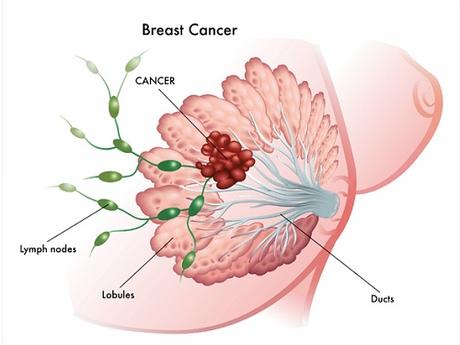 Deodorant Alternatives for Avoiding Breast Cancer