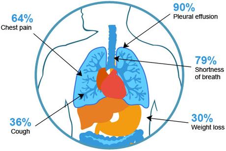 Image result for what is the symptoms of mesothelioma