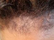 Causes Hairloss Women