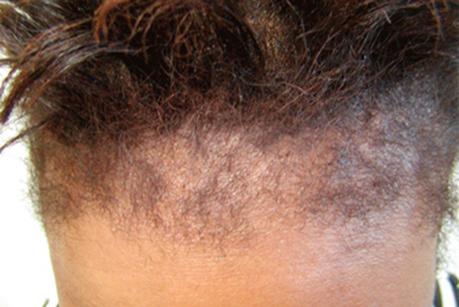 Six Causes Of Hairloss In Women