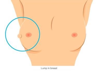 6 Symptoms of Breast Cancer