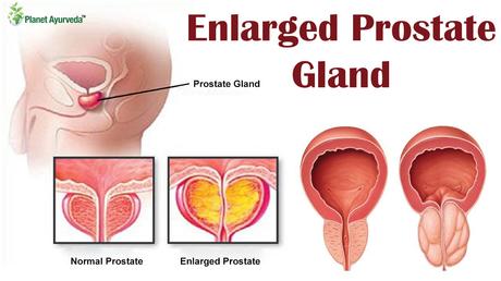 7 Amazing Superfoods to Prevent an Enlarged Prostate