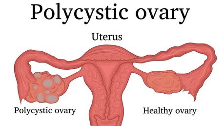 PCOS and hyperandrogenism – PCOS 7