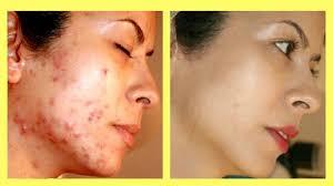 Tips! Get Rid Of Your Acne Scars For Good
