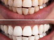 Tips Naturally Whiten Your Teeth Home