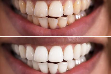 Tips To Naturally Whiten Your Teeth At Home