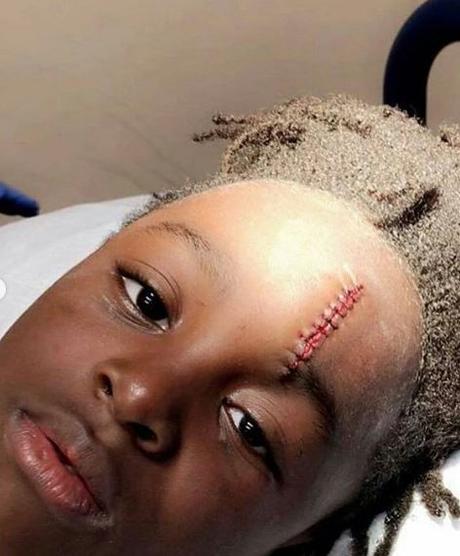 Little Boy Brutally Injured by his Classmate For Refusing to Share His Breakfast With him (Graphic Photos)