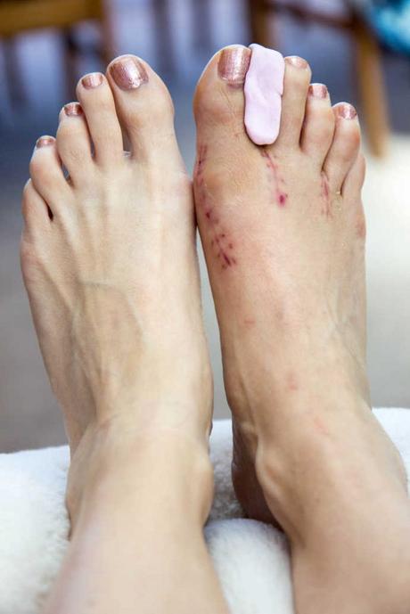 4 Weeks Post Bunion Surgery Update 4 Weeks Post Bunion Surgery Update