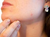 Simple Hacks Deal With Pimple Quickly