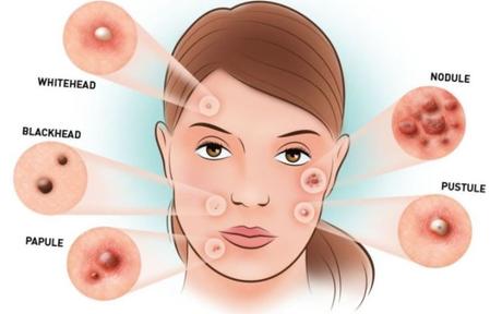 Image result for causes of acne