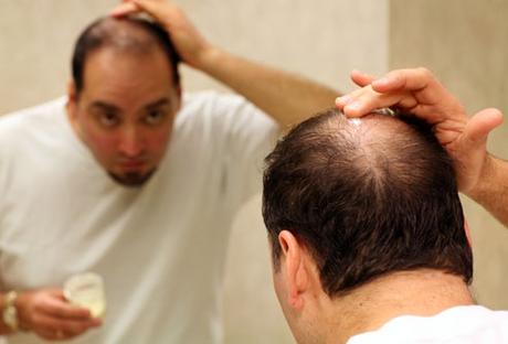 Male Hair Loss: 6 Common Reasons Why Young Men Start Losing Hair