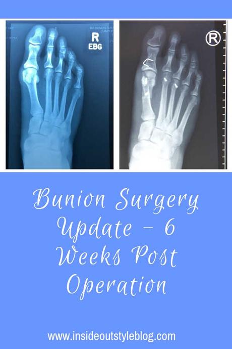 Bunion Surgery Update – 6 Weeks Post Operation