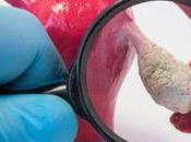 PCOS Hyperinsulinemia