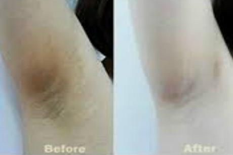 Use of creams can be a sure way to clear dark armpits and underarms. 