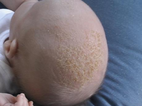 Skin Rashes in Babies and Toddlers