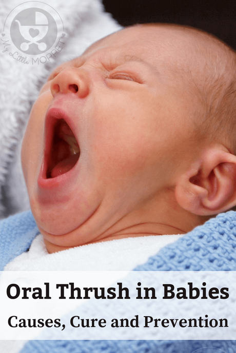 Oral Thrush in Babies is mostly harmless but can cause some discomfort.Learn all about what causes oral thrush,how to prevent it & keep baby's tongue clean.