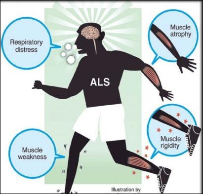 Is There Any Solution of Amyotrophic Lateral Sclerosis?Treatment & Management