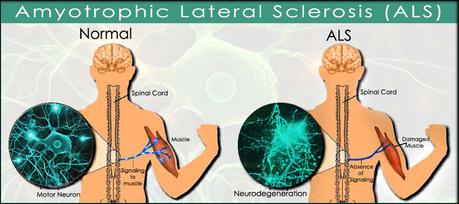 Is There Any Solution of Amyotrophic Lateral Sclerosis?Treatment & Management