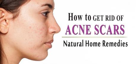 How to Get Rid of Acne Scars Fast? Top 5 Natural Home Remedies