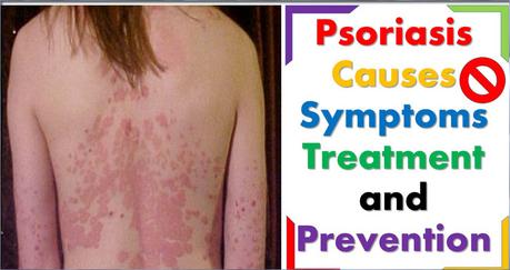 What is Psoriasis,Causes,Symptoms,Treatment And Diet? – Let’s Discuss